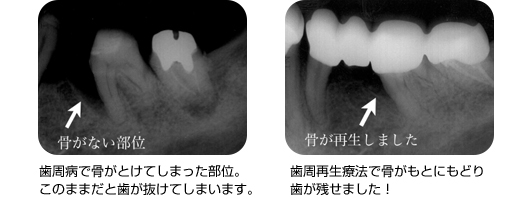 歯周病予防